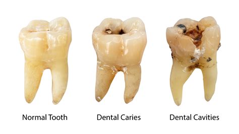 DECAY Meaning in Tagalog .
